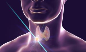 Nodulo tiroideo: quando bisogna asportarlo
