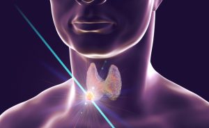 Nodulo tiroideo: quando bisogna asportarlo