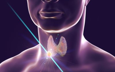 Nodulo tiroideo: quando bisogna asportarlo