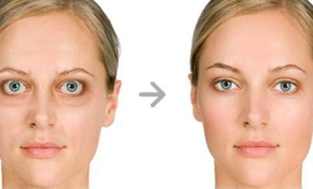 Morbo di Basedow: quando la malattia della tiroide colpisce gli occhi