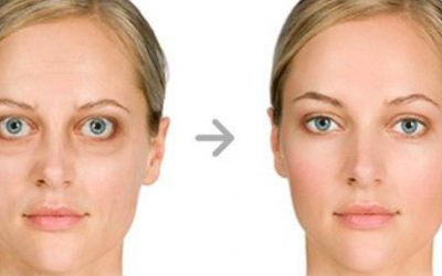 Morbo di Basedow: quando la malattia della tiroide colpisce gli occhi