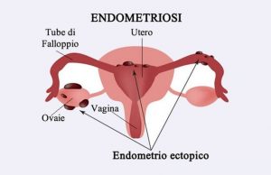 l'endometriosi