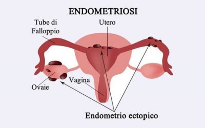 L’endometriosi