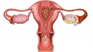 Cura dell'ovaio policistico