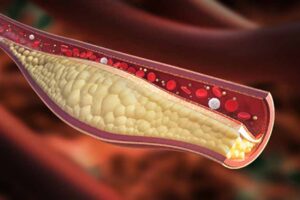 Pnei e Statine: non vanno dimenticati gli effetti avversi non cardiovascolari